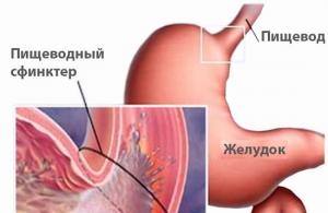 Несварение кишечника симптомы лечение